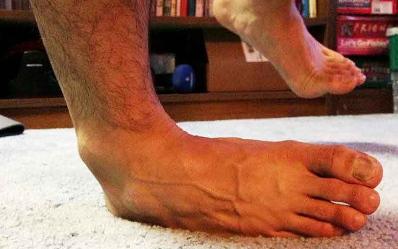 entorse externe de la cheville